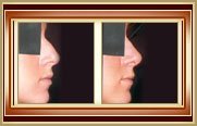 Rhinoplasty before and after photo
