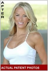 breast implant
