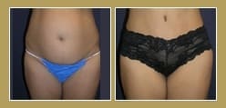Abdominoplasty Abdominoplasty