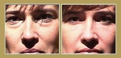 Blepharoplasty Blepharoplasty