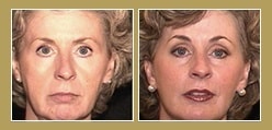 Brow Lift Brow Lift