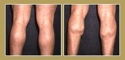 Calf Implants Calf Implants