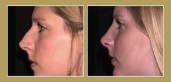 Rhinoplasty Rhinoplasty