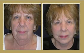 facelift
