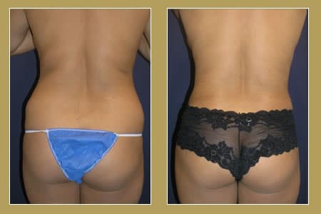 liposuction
