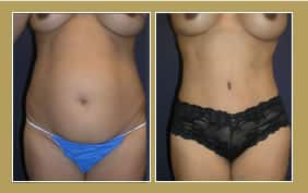 tummy tuck