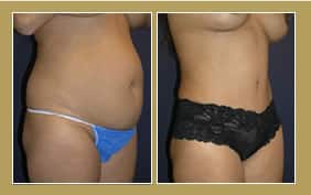 tummy tuck actual patient
