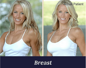 breast-gall