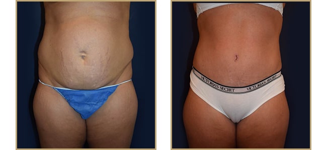 Abdominoplasty 310