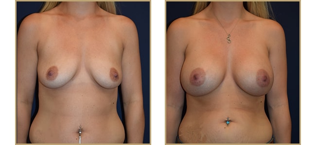 Breast Augmentation Before & After Photos Baltimore Maryland