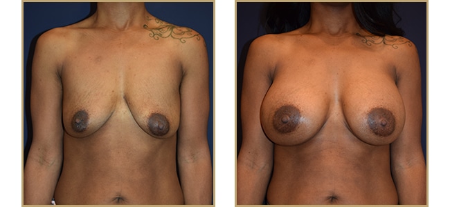 Breast Augmentation 40