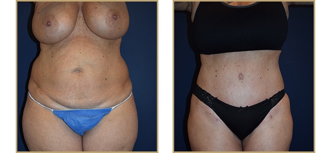 Abdominoplasty 330