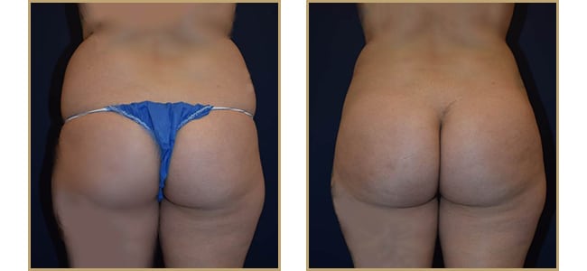 Buttock Augmentation 10