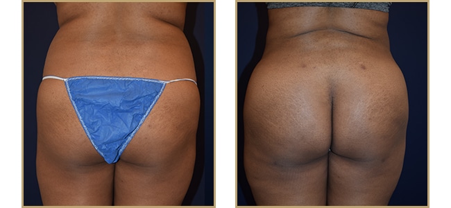 Buttock Augmentation 20