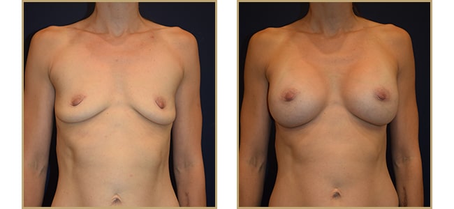 Breast Augmentation 410