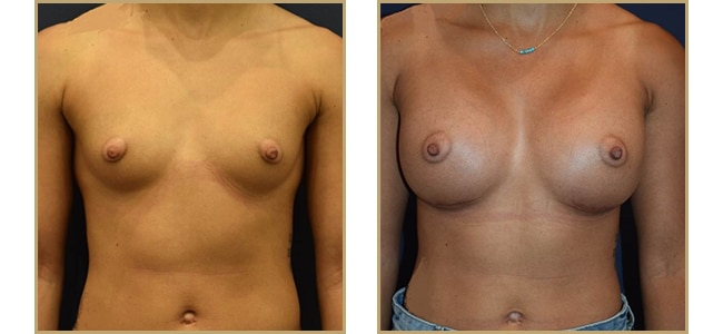 Breast Augmentation 420