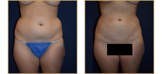 Liposuction Case 130