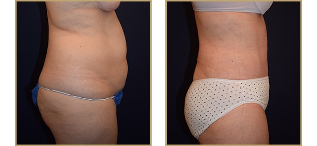 Tummy Tuck & Mini Tummy Tuck for Baltimore, Ellicott City